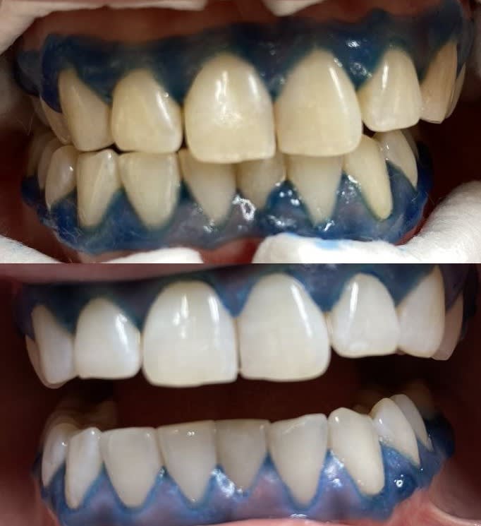 Відбілювання зубів Magic Smile Львів