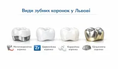 Коронки на зуби