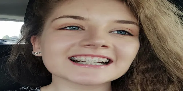 Брекети та ортодонтія у стоматолога Львіва