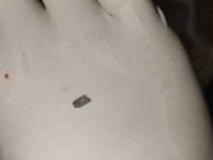 Ульяновец более 20 лет проходил с обломком электроплиты в груди