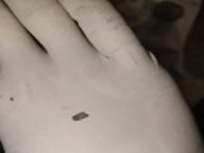 Ульяновские хирурги извлекли из груди пациента обломок электропилы