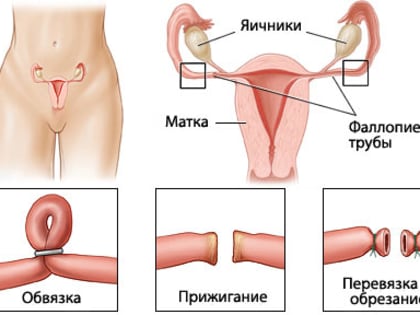 Как лечится непроходимость маточных труб