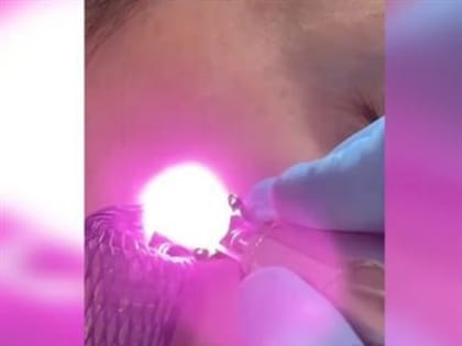 Юлин топчик. Нужно ли удалять родинки