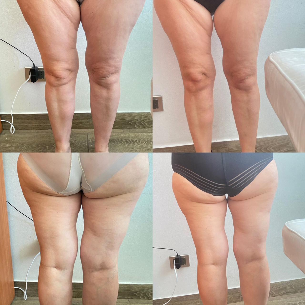 Antes y después - Hifu Corporal