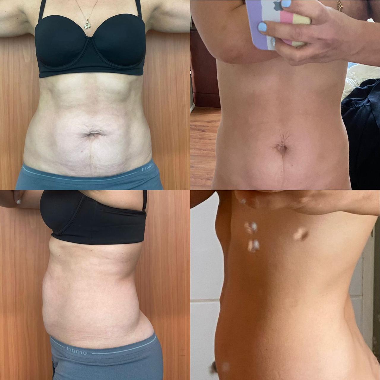 Antes y después - Hifu Corporal
