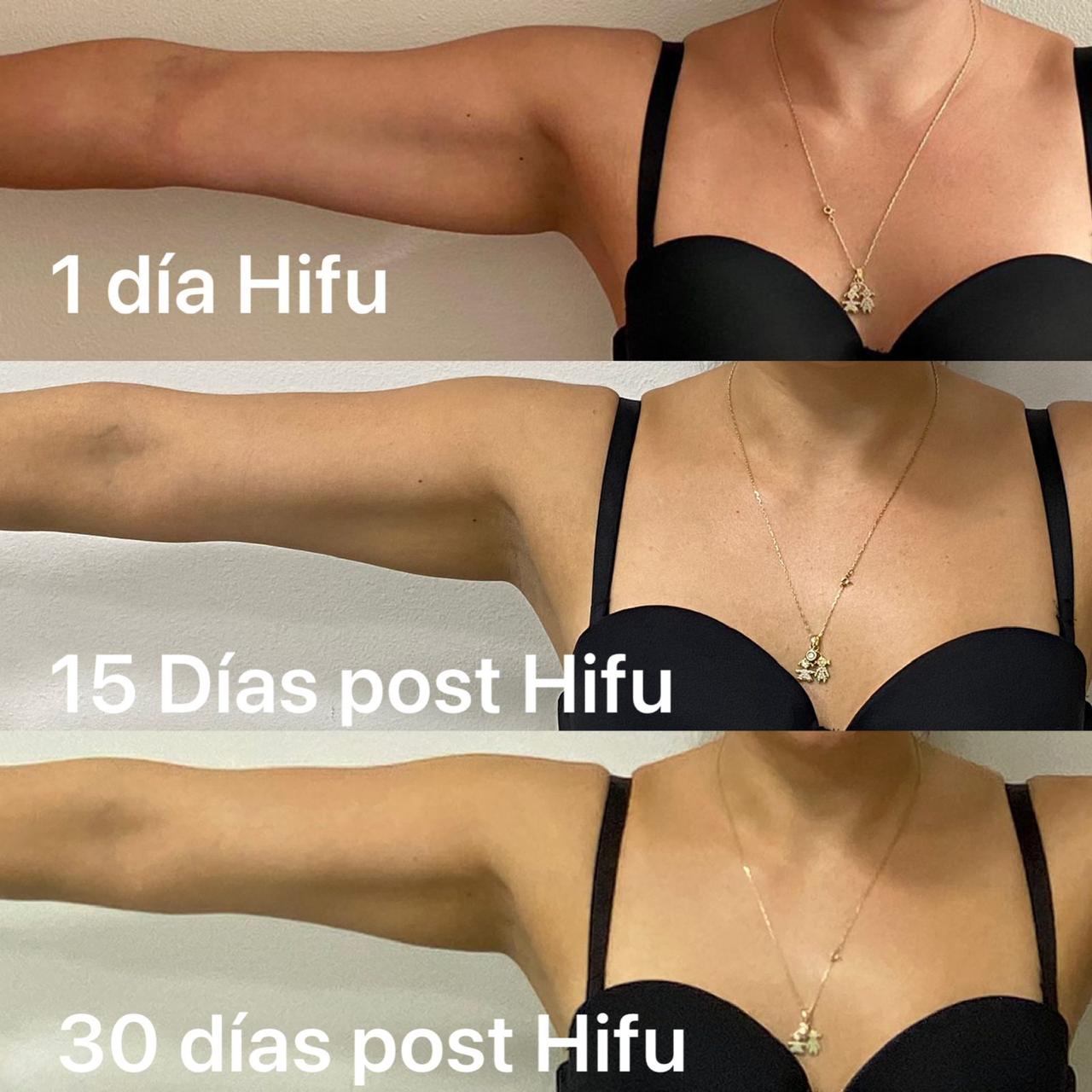 Antes y después - Hifu Corporal
