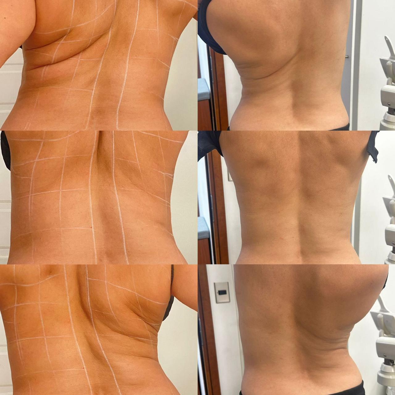 Antes y después - Hifu Corporal