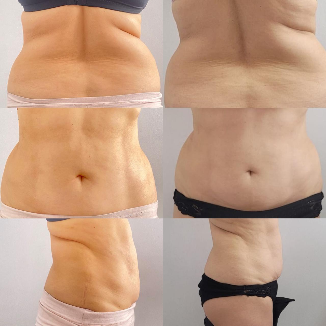 Antes y después - Criolipólisis