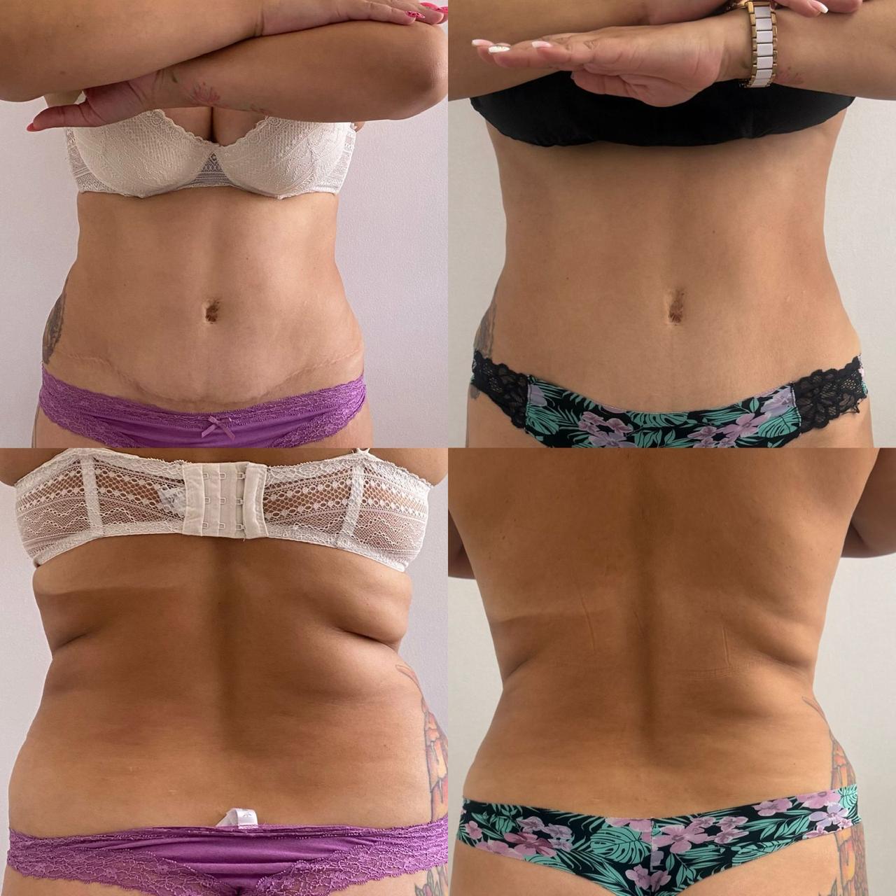 Antes y después - Criolipólisis