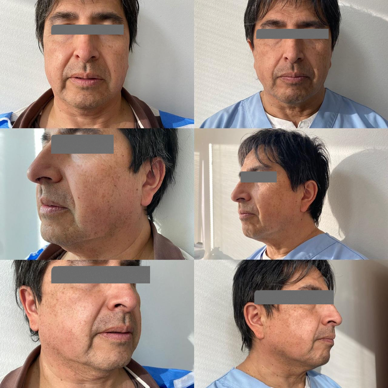 Antes y después - Armonización Facial