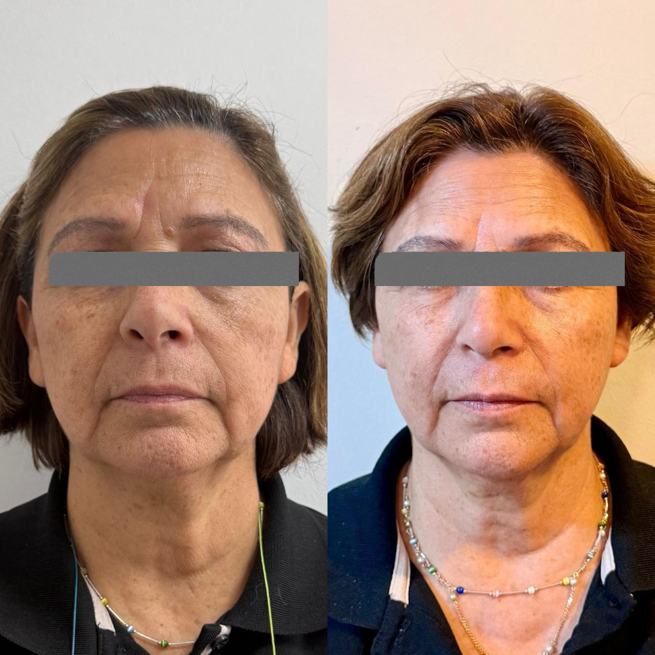 Antes y después - Armonización Facial