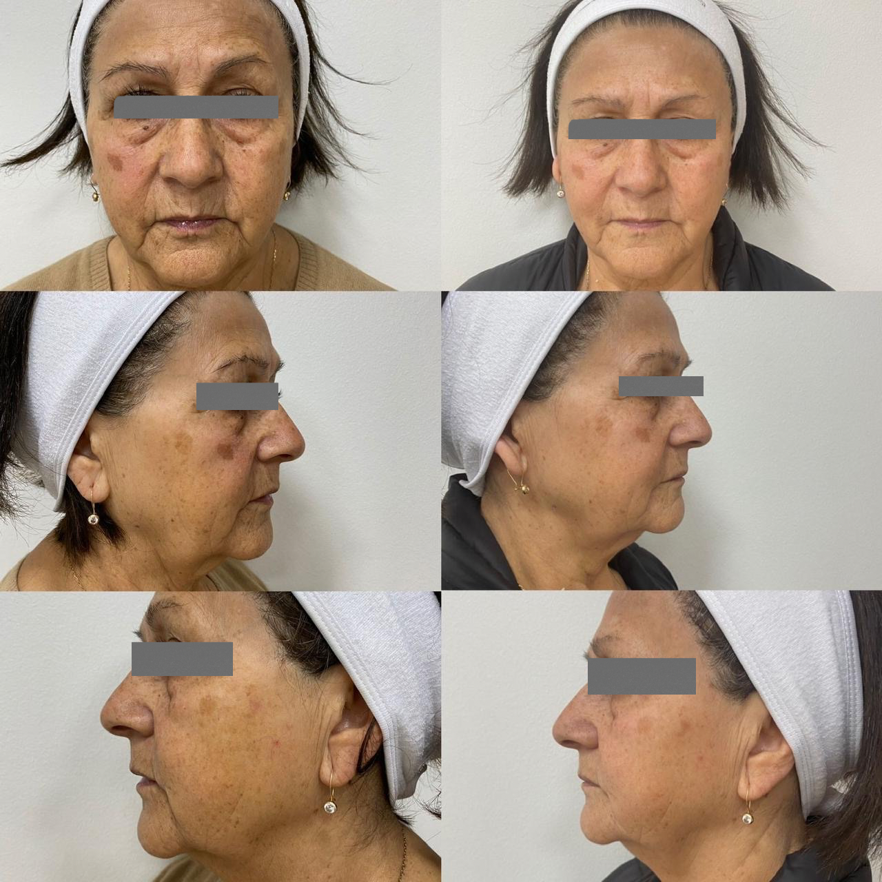 Antes y después - Armonización Facial
