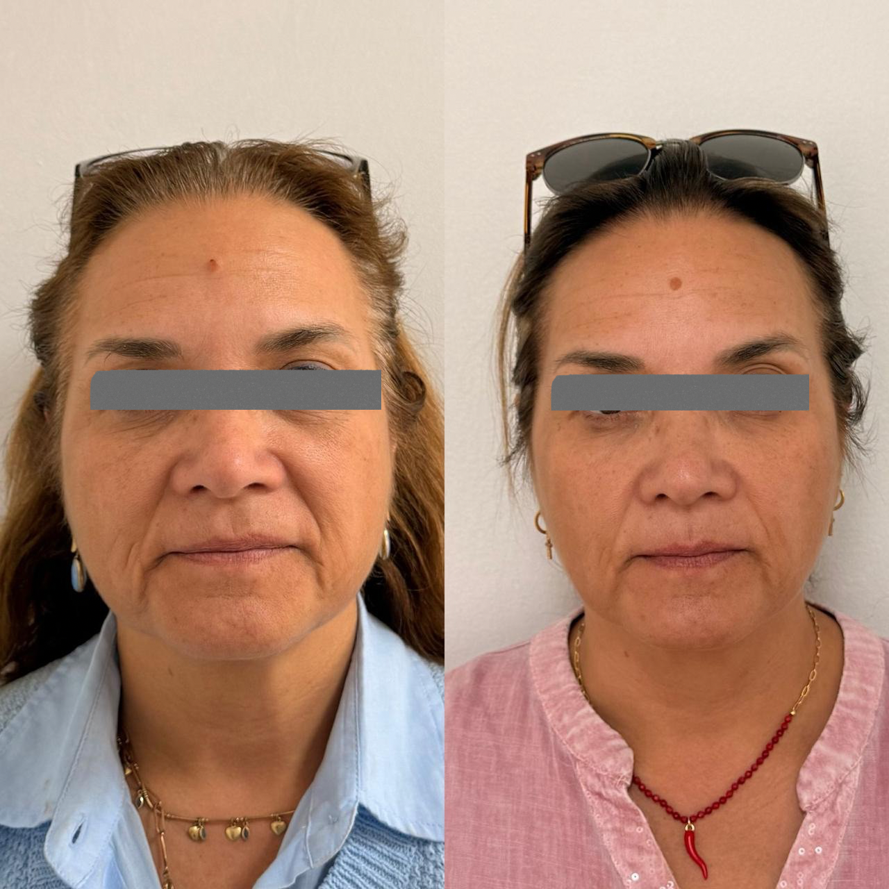 Antes y después - Armonización Facial