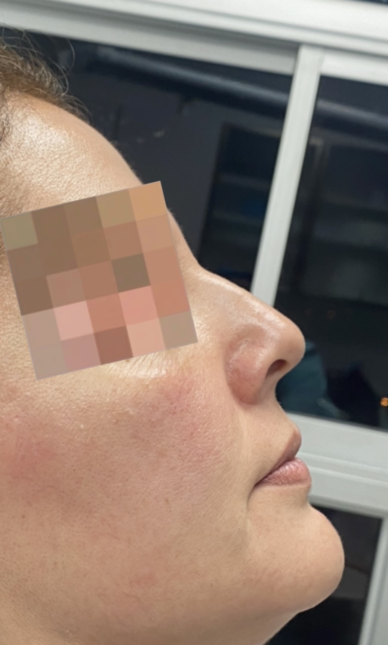 Antes - resultado estética facial