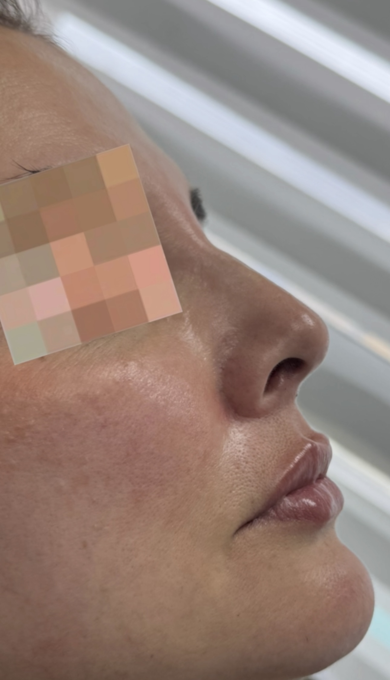 Después - resultado estética facial