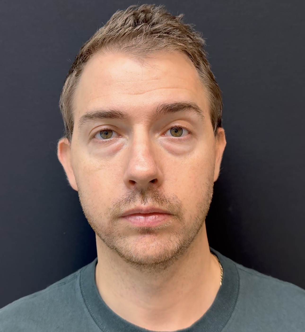 Antes - resultado estética facial