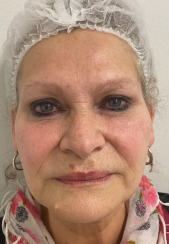 Después - resultado estética facial