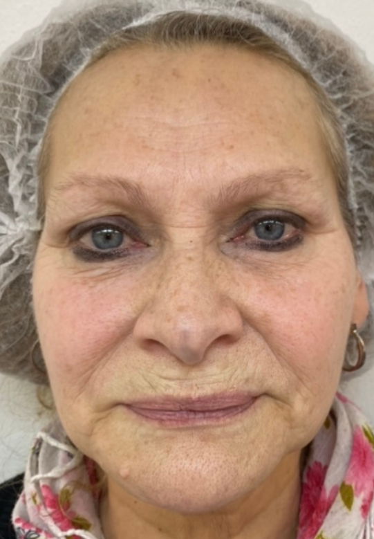 Antes - resultado estética facial
