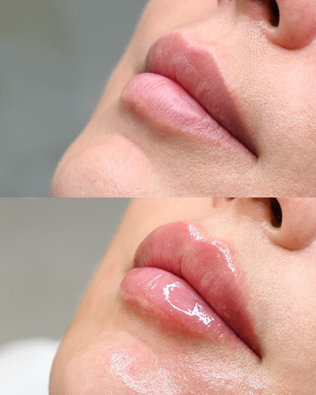 Resultado Perfilado de Labios - Clínica Vancouver