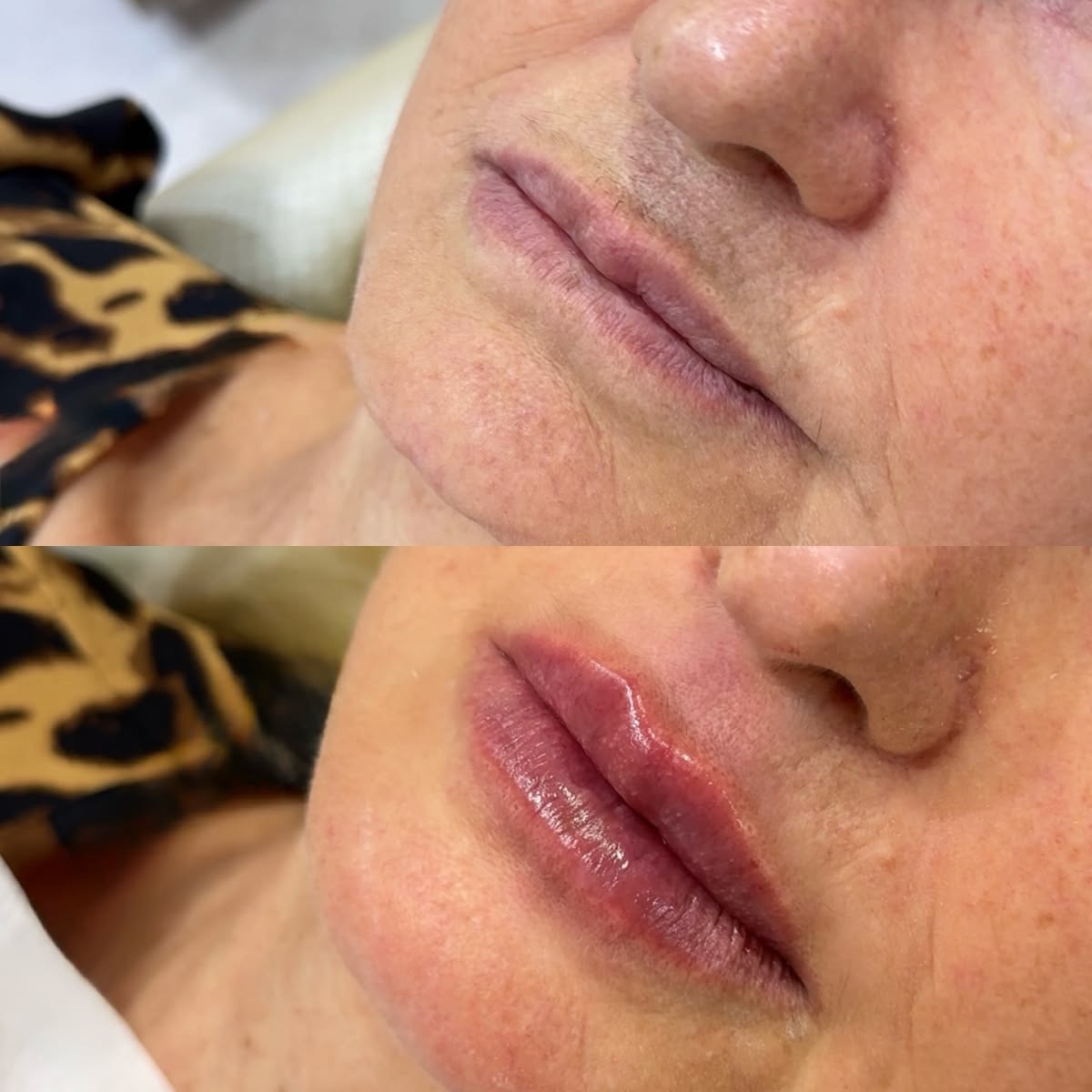 Resultado Perfilado de Labios - Clínica Vancouver