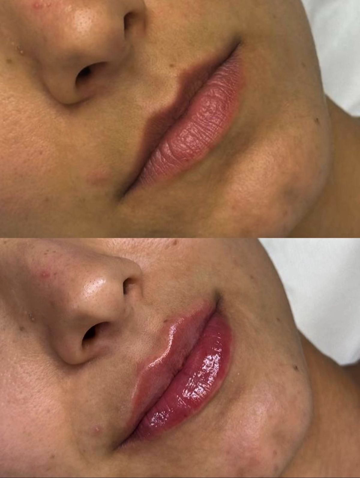 Resultado Perfilado de Labios - Clínica Vancouver