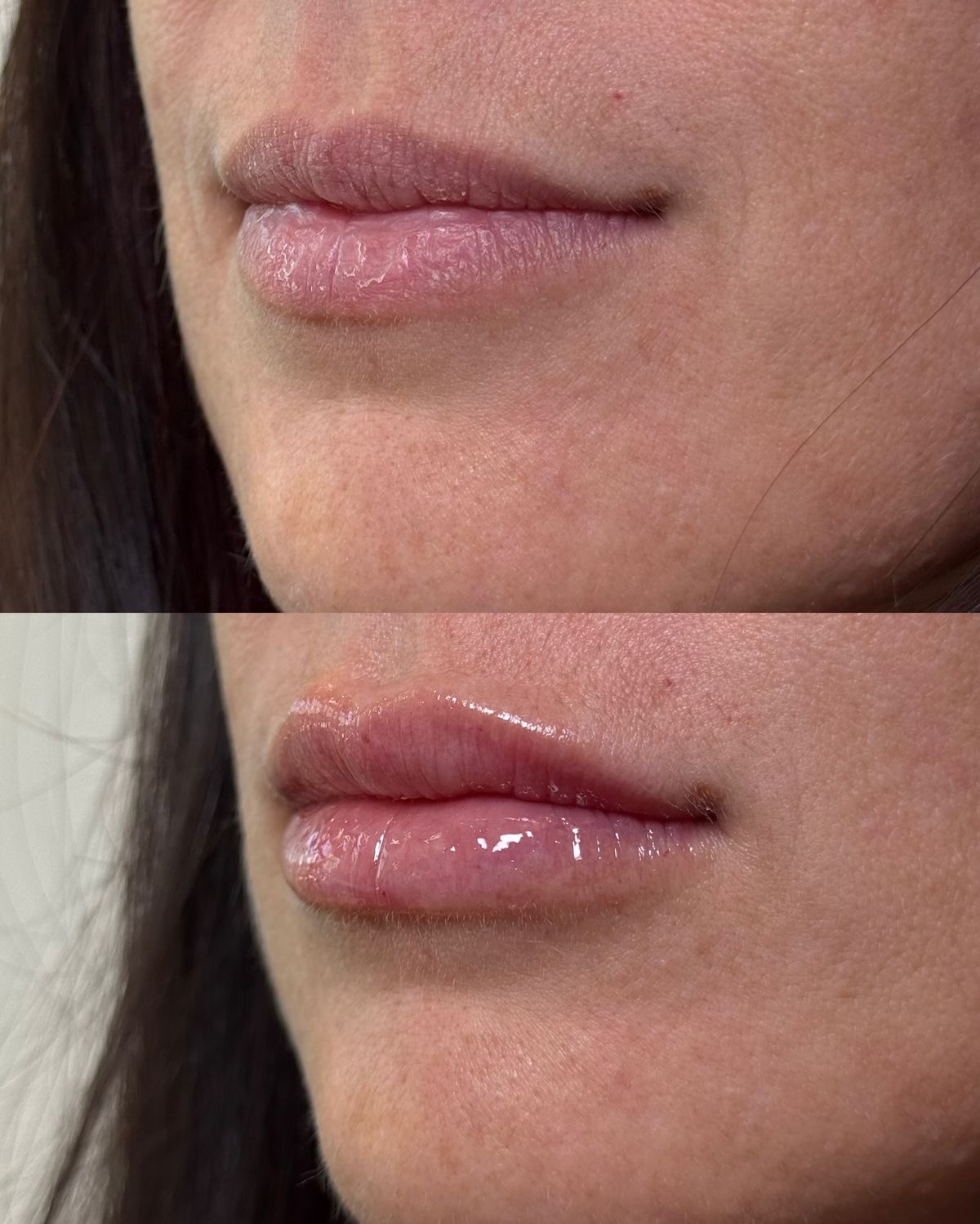 Resultado Perfilado de Labios - Clínica Vancouver