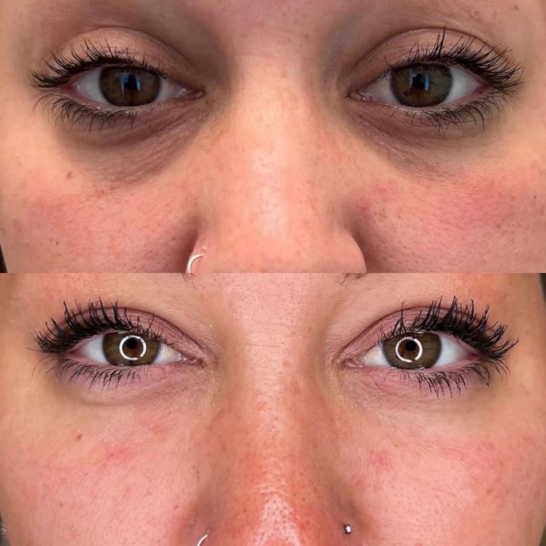 Resultado Tratamiento de Ojeras - Clínica Vancouver