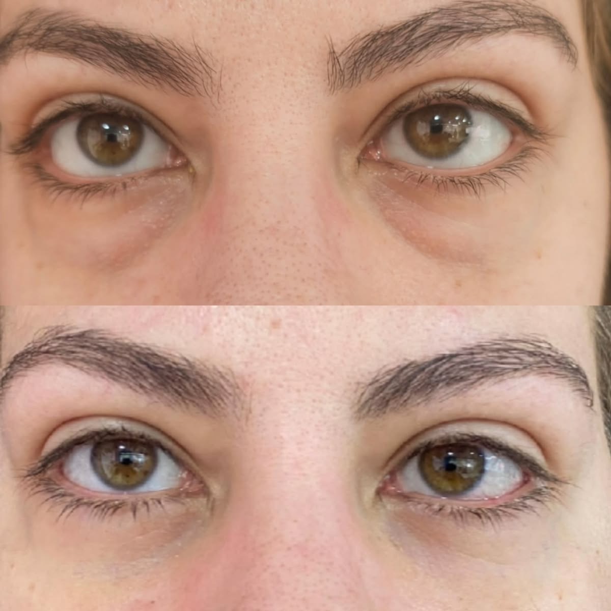 Resultado Tratamiento de Ojeras - Clínica Vancouver