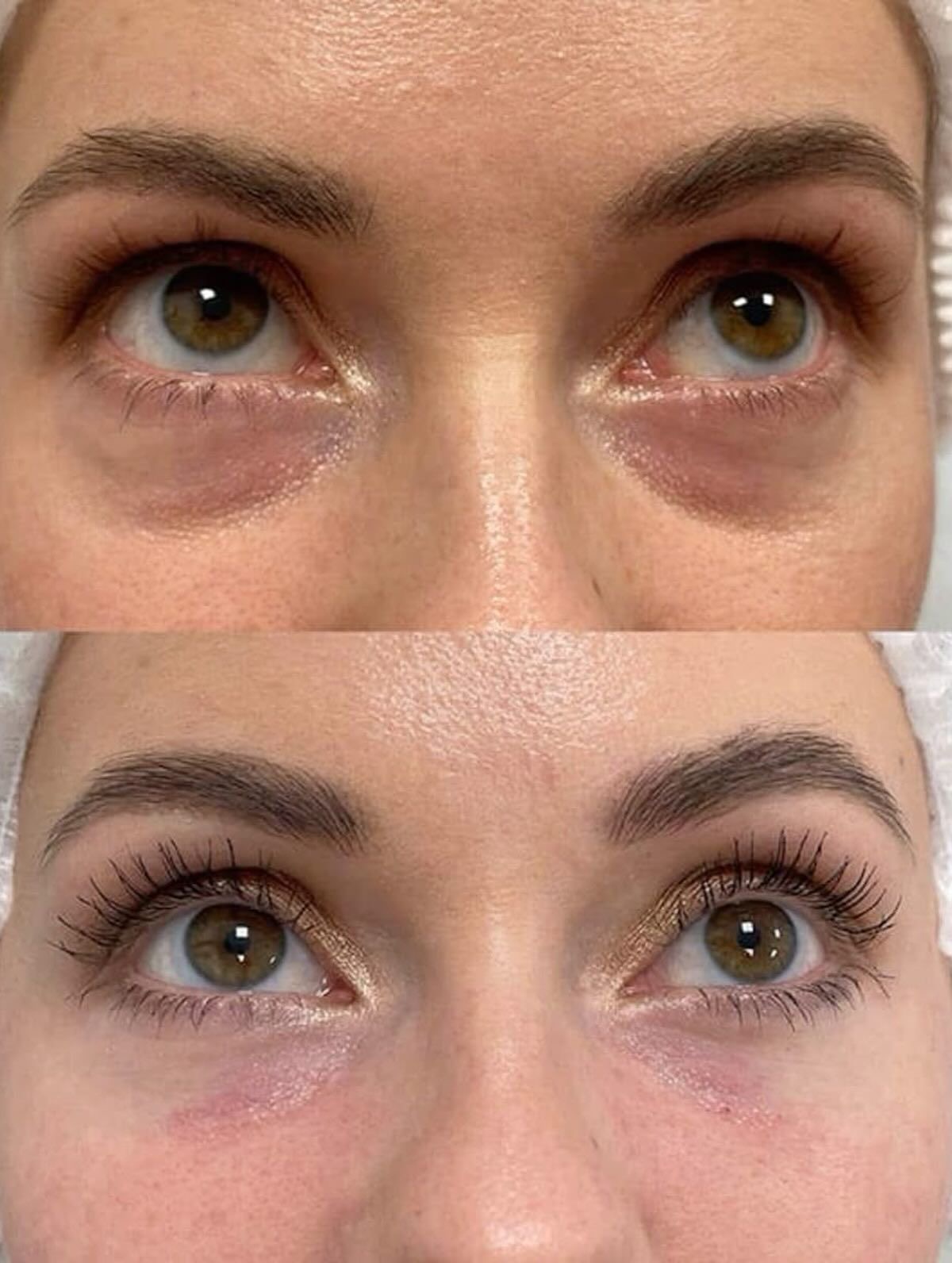 Resultado Tratamiento de Ojeras - Clínica Vancouver