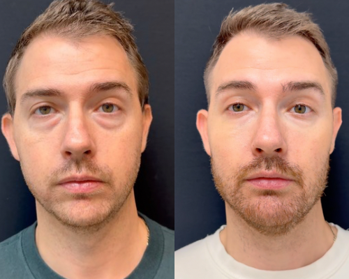 Resultado Tratamiento de Ojeras - Clínica Vancouver