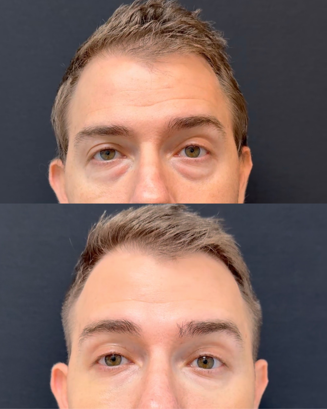 Resultado Tratamiento de Ojeras - Clínica Vancouver