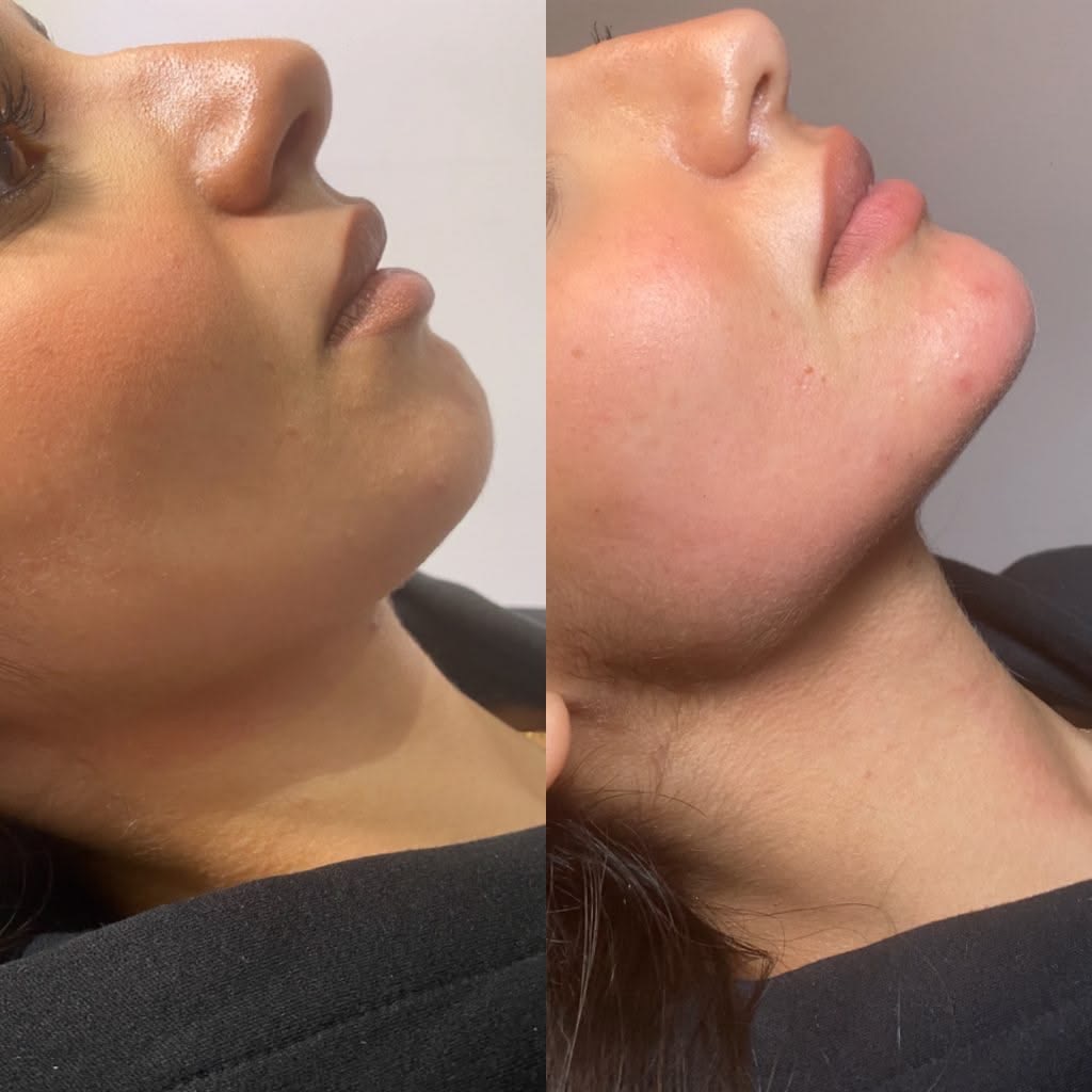 Resultado Perfilado Mandibular - Clínica Vancouver