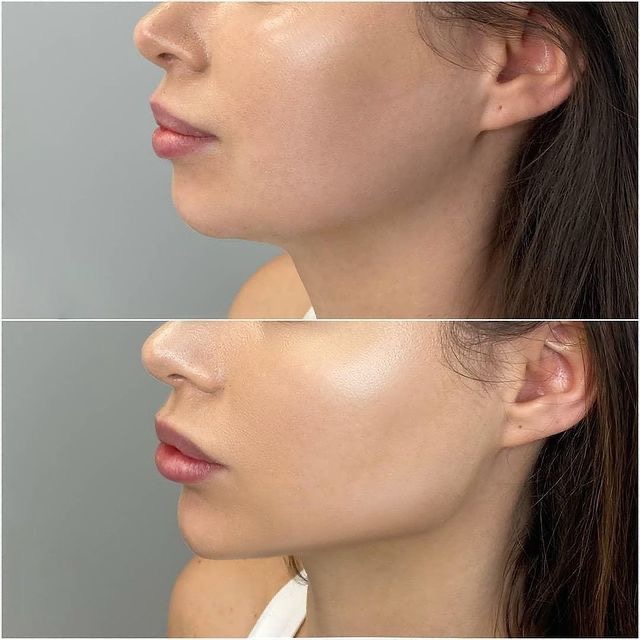Resultado Perfilado Mandibular - Clínica Vancouver