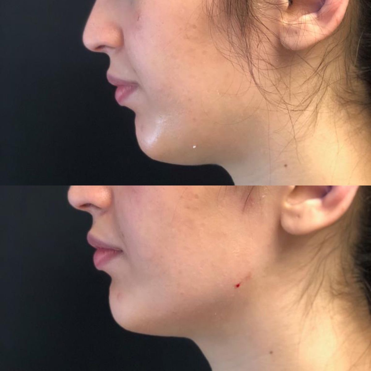 Resultado Lipopapada Enzimática - Clínica Vancouver