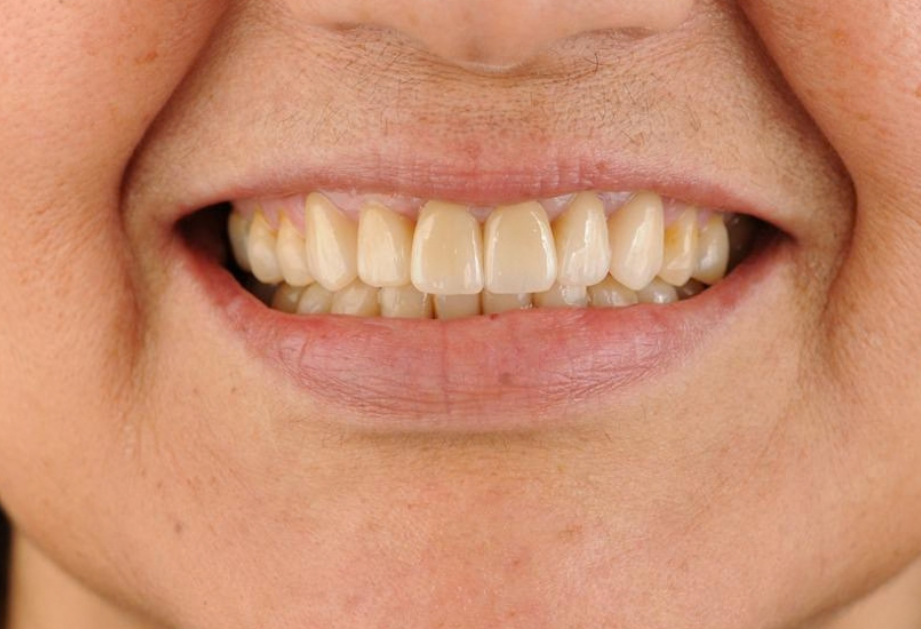 Antes del diseño de sonrisa con carillas de porcelana