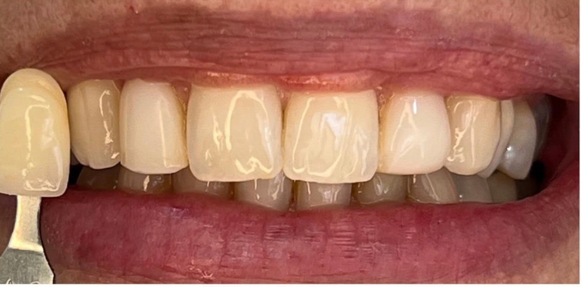 Dientes antes del blanqueamiento dental en Dental Vitacura