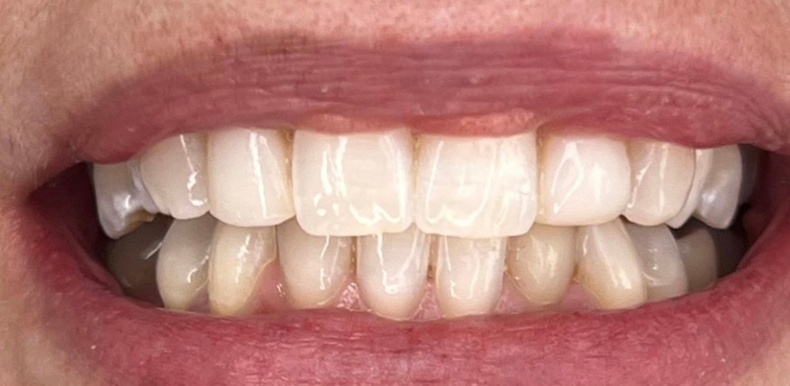 Dientes después del blanqueamiento dental con Philips Zoom en Dental Vitacura