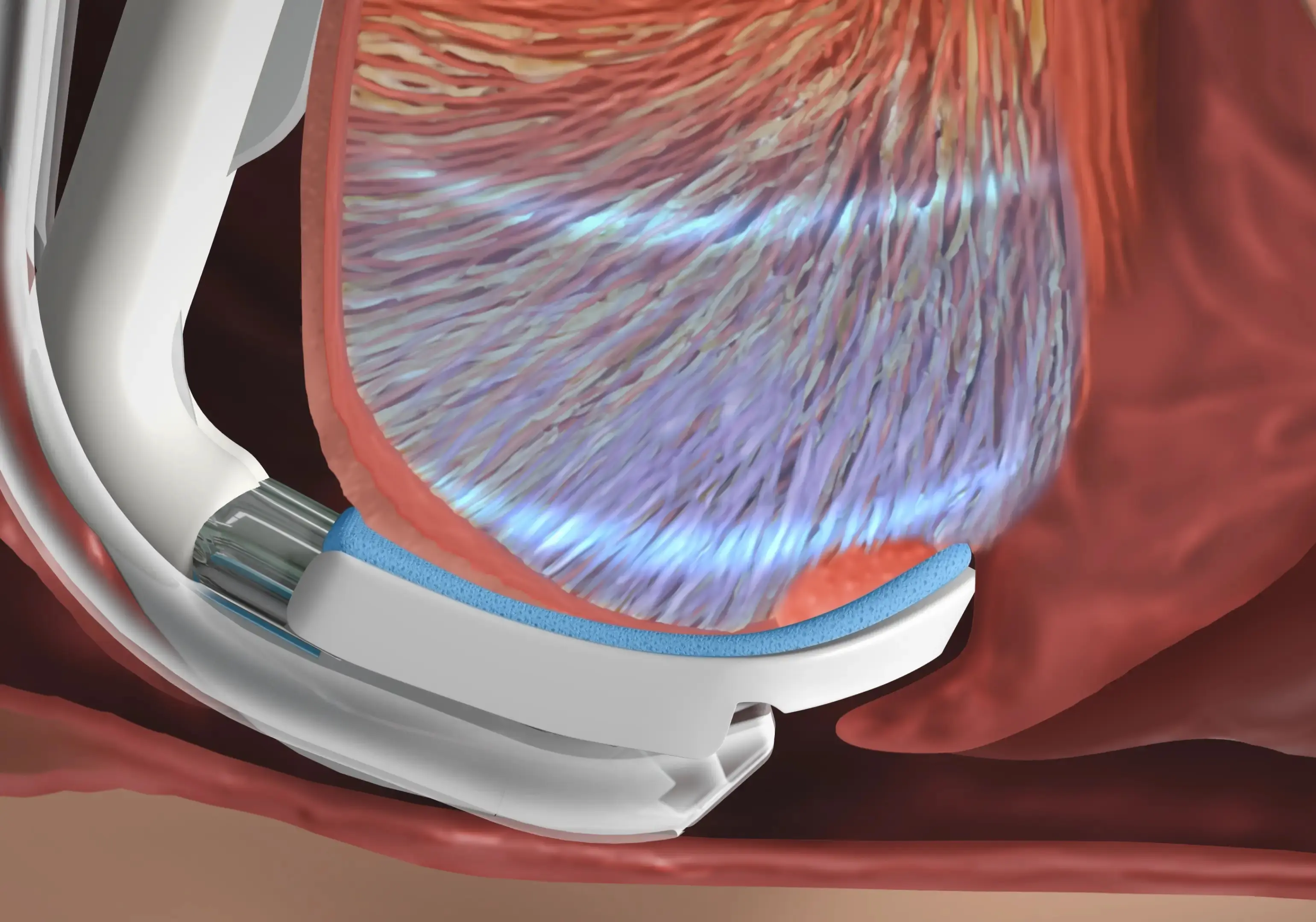 What is the Cryosa procedure?