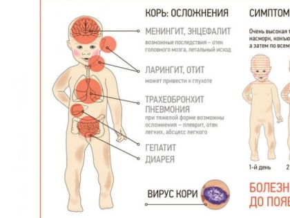 Не забывайте прививаться против кори