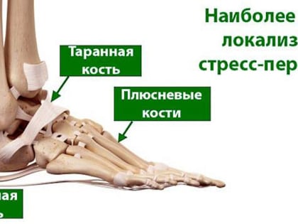 В Ростове медики рассказали, кому грозит стресс-перелом