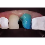 Травильний гель (37% ортофосфорної кислоти з антисептиком) Phospho-Jen AS (Фосфо-Джен AS) (Джендентал-Україна)