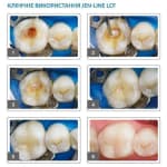 Jen-Line LCF (Джен-Лайн LCF), шпр.3г - Прокладка (лайнер), композитний (Джендентал-Україна)