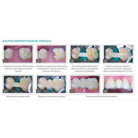 jen fiber bulk (Джен Файбер Балк), 6шт/пак форма: № 3; розм.= 1.8х30 мм Скловолоконні балки (скловолокно) (Джендентал Україна)