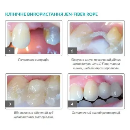 jen fiber rope (Джен Файбер Роуп), Пак.: 3 х шнур 9см діам.= 1.50 мм Шинуючий шнур (скловолокно) (Джендентал Україна)