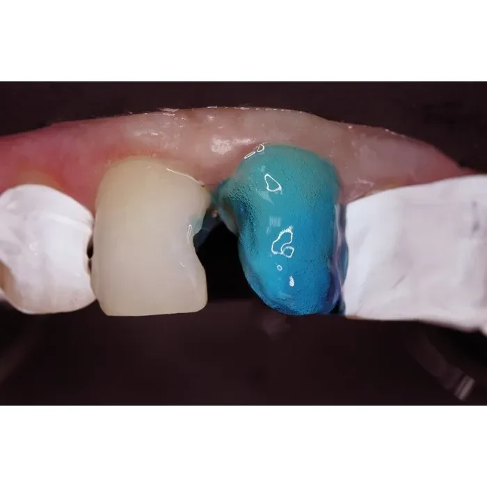 Травильний гель (37% ортофосфорної кислоти з антисептиком) Phospho-Jen AS (Фосфо-Джен AS) (Джендентал-Україна)