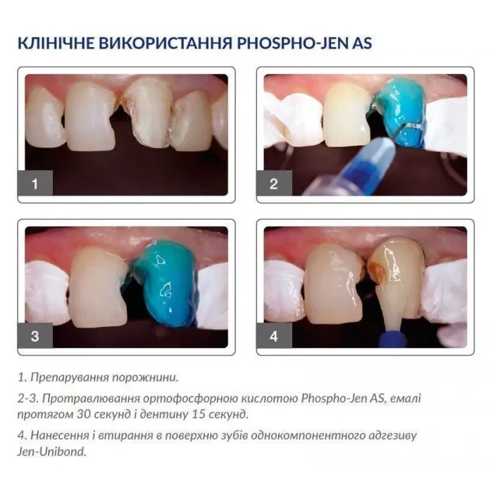 Травильний гель (37% ортофосфорної кислоти з антисептиком) Phospho-Jen AS (Фосфо-Джен AS) (Джендентал-Україна)