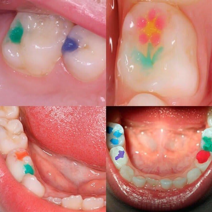 Jen-Rainbow (Джен-Рейнбоу), шпр.3.2г - Кольоровий композит, мікрогібридний текучий (Джендентал-Україна)