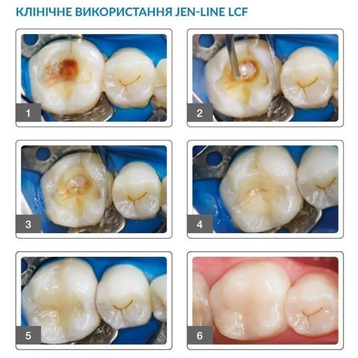 Jen-Line LCF (Джен-Лайн LCF), шпр.3г - Прокладка (лайнер), композитний (Джендентал-Україна)