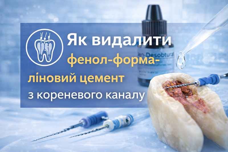 Видалення фенол формалінового цементу з кореневого каналу – ендодонтичні інструменти та розчинник compressed