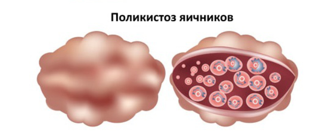 Признаки яичников. (Синдром поликистозных яичников, синдром Штейна-Левенталя). Синдром Штейна-Левенталя (поликистоз яичников). Поликистоз яичников Штейна Левенталя. Поликистоз яичников макропрепарат.